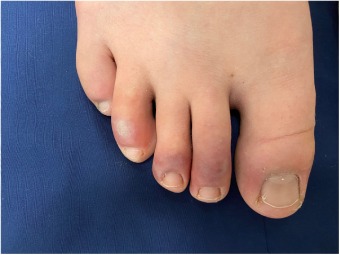 COVID-19 có thể đi kèm tình trạng sưng đỏ, tím ở ngón tay, ngón chân