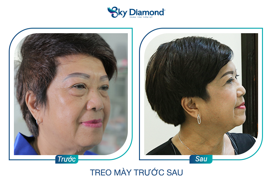 Cô Tuyết Mai sau treo mày xong, tình trạng sụp mí và bọng mỡ được cải thiện rõ. Ảnh: Sky Diamond cung cấp