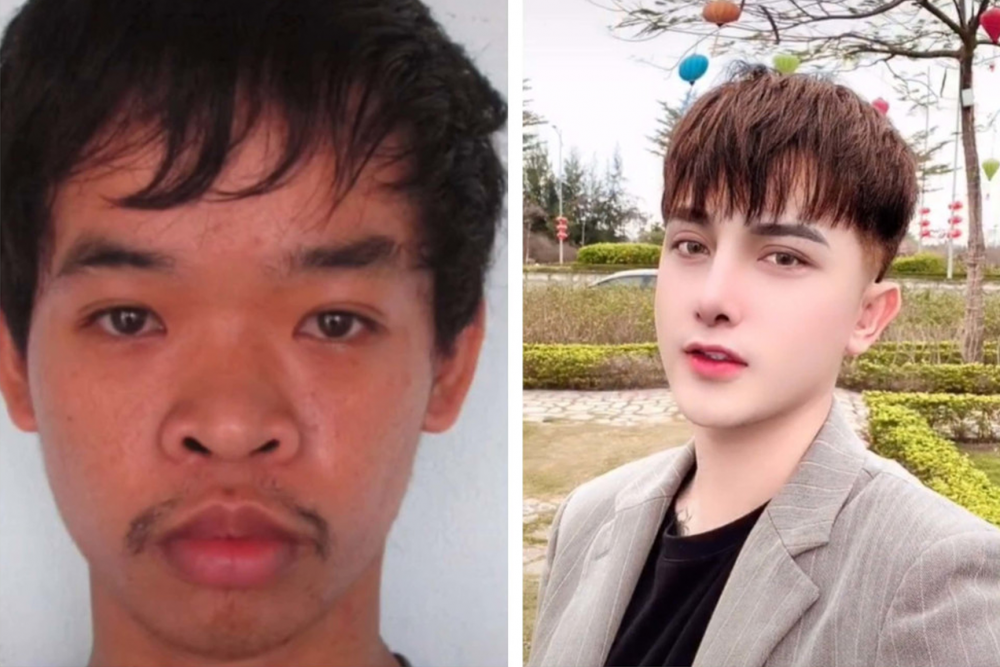 Bức ảnh trước và sau khi phẫu thuật của Đỗ Văn Quyền gây chú ý trên báo Hàn