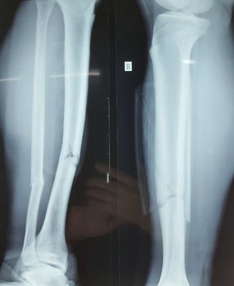 Hình ảnh X-quang cho thấy Hùng Dũng bị gãy cả xương chày và xương mác