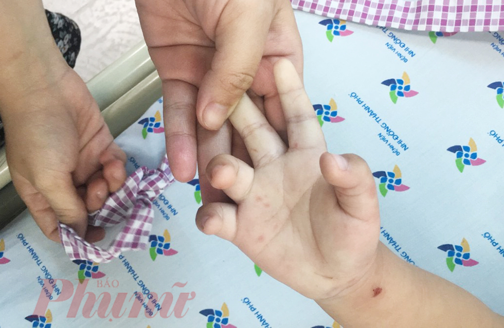 Bệnh viện Nhi Đồng TP.HCM tiếp nhận nhiều ca trẻ bị tay chân miệng nặng, biến chứng thần kinh (Ảnh Phạm An)