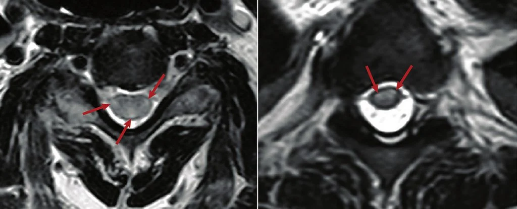 Ảnh cụp MRI cho thấy một bệnh nhân COVID-19 bị viêm tủy ngang cấp tính
