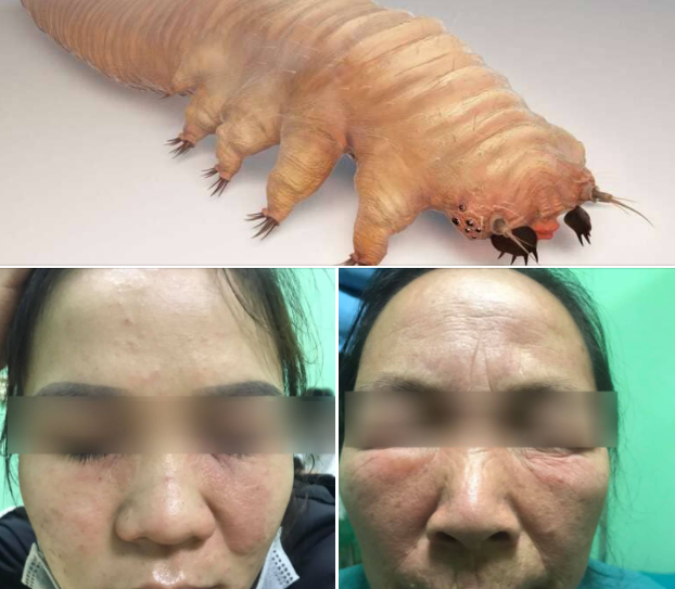 Nữ bệnh nhân rụng mi, đỏ sần da mặt vì ký sinh trùng Demodex