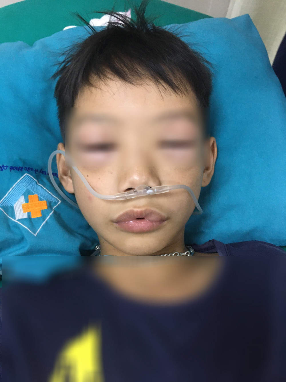 Bé trai 10 tuổi sốc phản vệ sau khi uống thuốc ho sốt