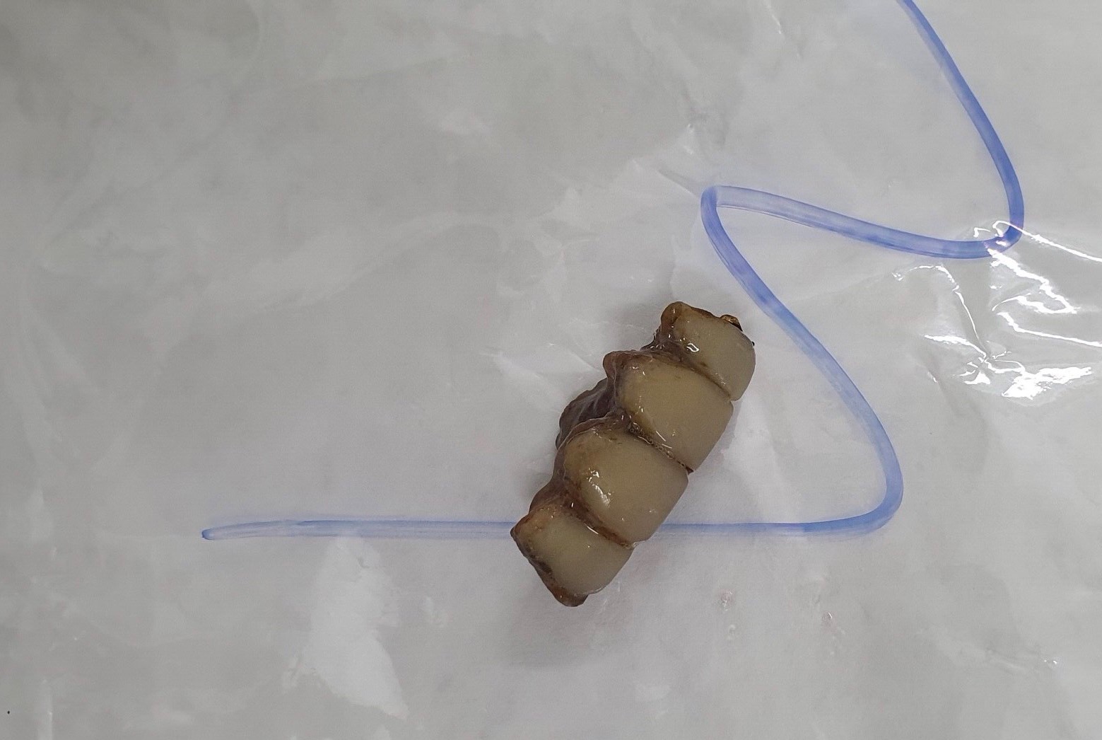 Nguyên hàm răng giả 4 chiếc sau khi được lấy ra 
