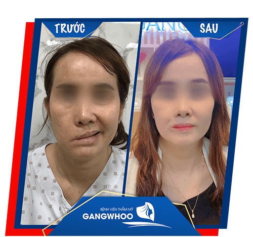 Hình ảnh khách hàng sau điều trị liệt mặt tại bệnh viện. Ảnh: BVTM Gangwhoo
