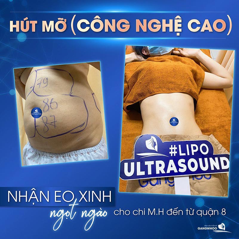 Chị M.H đến từ quận 8 hoàn toàn hài lòng về chiếc eo sau khi hút mỡ công ngệ cao