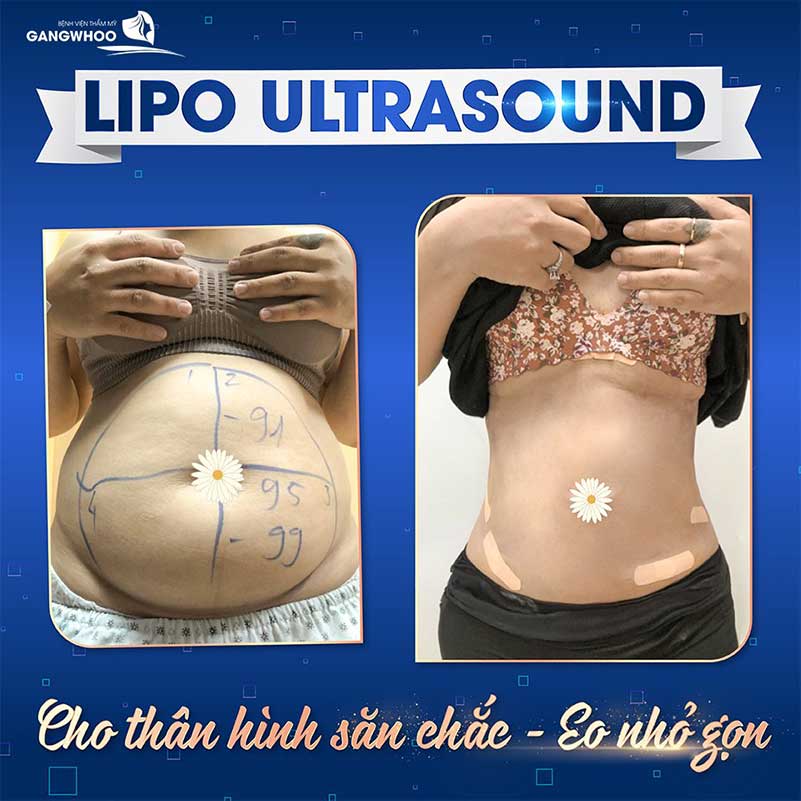 Bụng và eo thon gọn nhanh chóng sau 1 lần thực hiện công nghệ Lipo Ultrasound