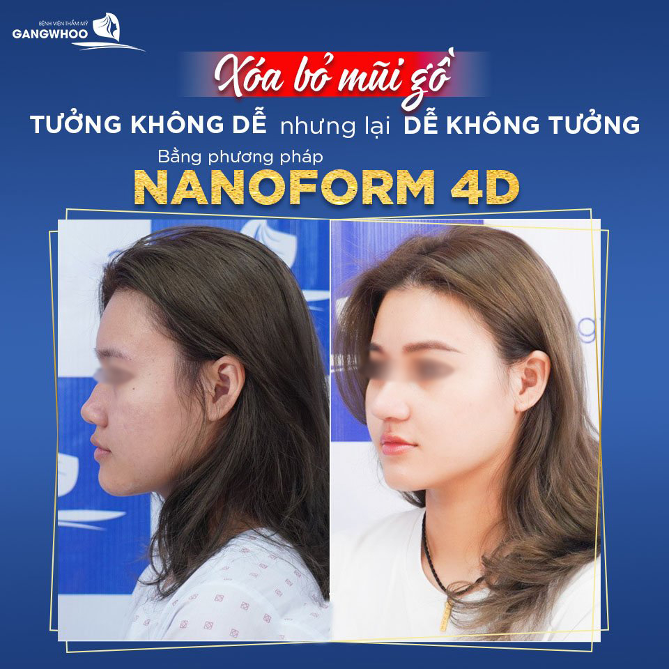 Nâng mũi (Nanoform 4D) cho chiếc mũi hoàn hảo theo đúng chuẩn tỷ lệ vàng. Ảnh: Gangwhoo