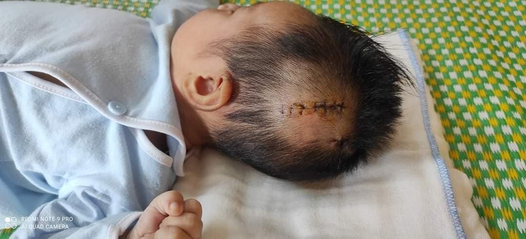 Sốt cao, da vàng, thóp căng phồng... bé gái 2 tháng tuổi được phát hiện xuất huyết não