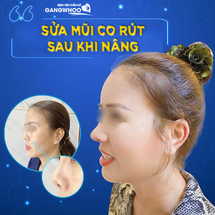 Mũi khách hàng bị co rút, và trình trạng mũi hiện tại của khách hàng - Ảnh: Gangwhoo