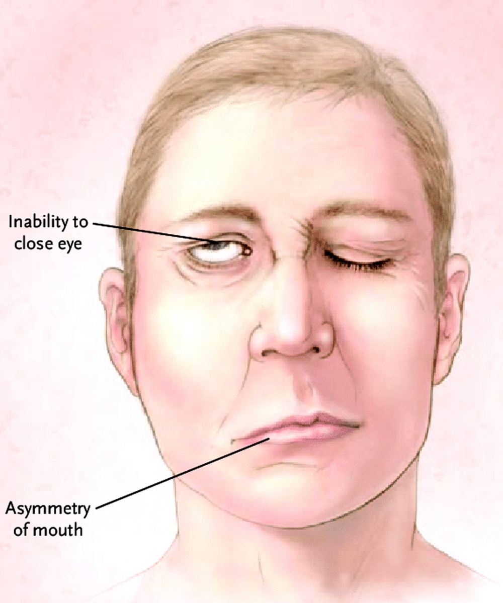 Khuôn mặt biến dạng điển hình khi bị liệt mặt