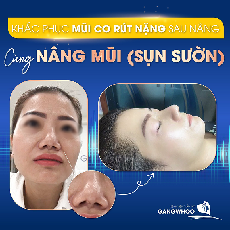 Xóa bỏ tự ti vì chiếc mũi hỏng sau 60 phút phẫu thuật - Ảnh: Gangwhoo