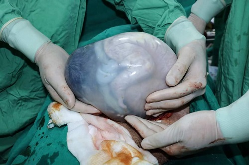 Em bé chào đời còn nguyên trong bọc ối, thấy rõ cả chân tay.