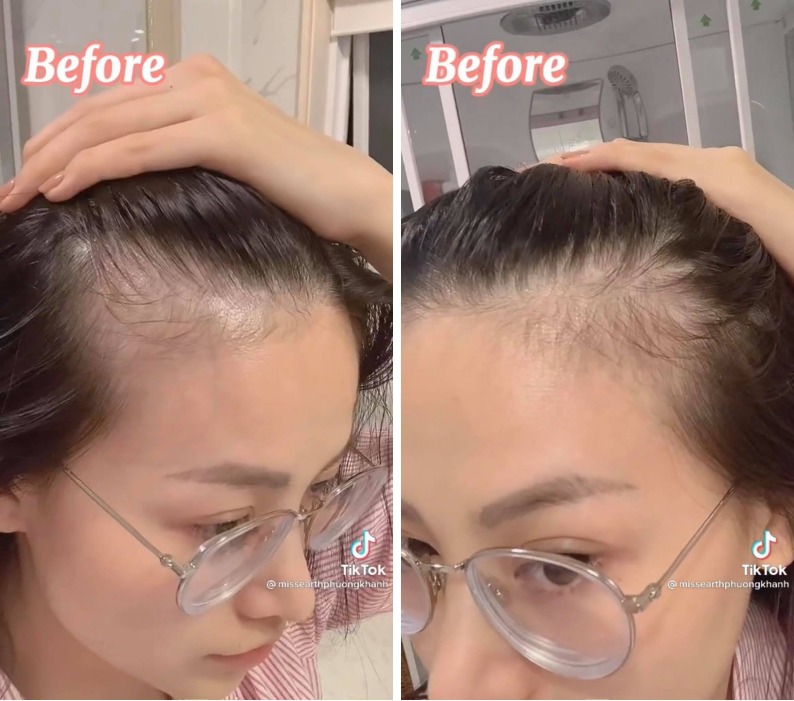 Mái tóc của Phương Khánh bị rụng khá nhiều hai bên thái dương.
