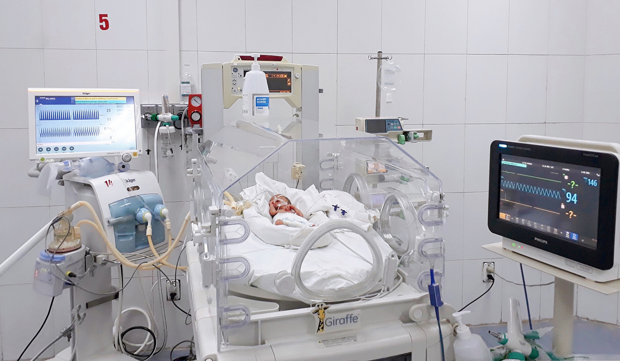 Bé A.B. được thở máy tần số cao HFO tại Khu Cách ly của Bệnh viện Sản Nhi Bắc Giang