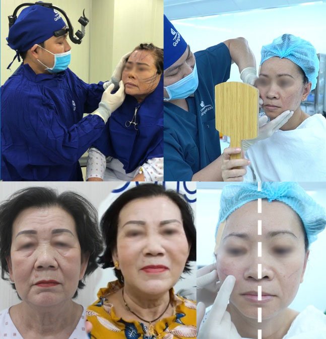 Bác sĩ BVTM Gangwhoo kiểm tra, so sánh tình trạng da mặt của bệnh nhân sau khi căng da mặt 1 bên - Ảnh do BVTM Gangwhoo cung cấp
