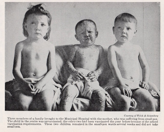 Bức tranh cho thấy em bé ở giữa bị bệnh đậu mùa nặng do không tiêm vắc xin, 2 em bé ngồi 2 bên đã được tiêm vắc in ngừa trước đó một năm nên không bị ảnh hưởng bởi dịch bệnh - Ảnh tư liệu chụp năm 1924
