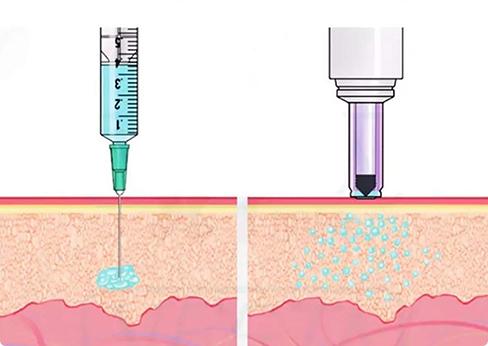 Vắc xin truyền thống được tiêm bằng kim tiêm (ảnh trái) và dụng cụ bom vắc xin ZyCoV-D vào da không cần kim tiêm (phải)