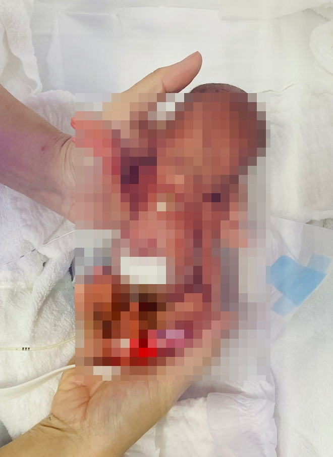 Bé gái sinh non nhỏ như chiếc xi lanh, nằm lọt thỏm trong bàn tay của nhân viên y tế