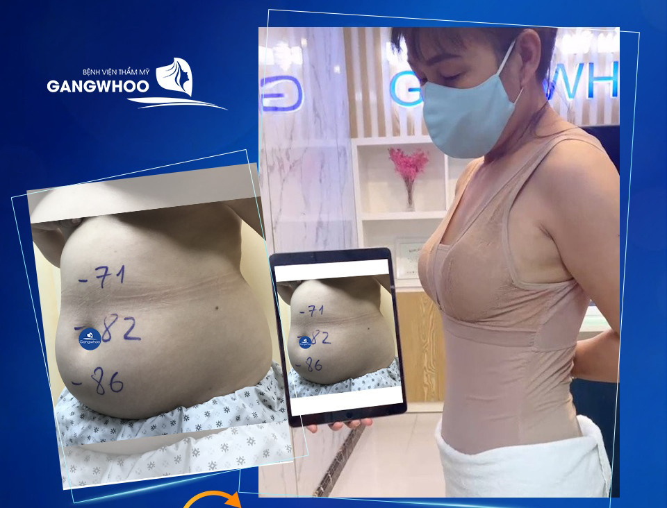 Chị Thảo sau khi sử dụng dịch vụ Lipo Ultrasound tại Bệnh viện thẩm mỹ Gangwhoo - Ảnh: Gangwhoo