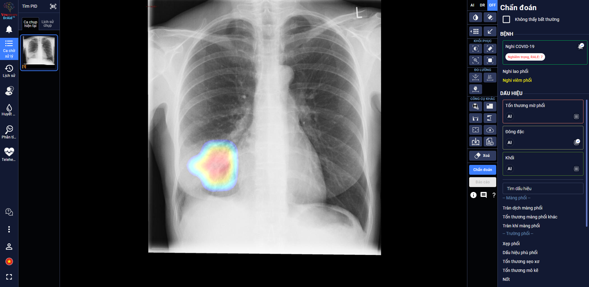 DrAid giúp bác sĩ theo dõi mức độ tổn thương phổi ở một bệnh nhân F0 trên ảnh X-quang phổi