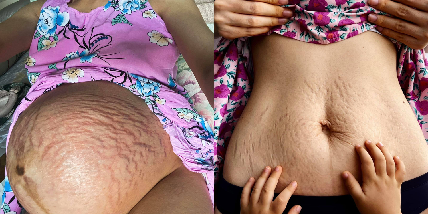 Hình ảnh vết rạn da trong khi mang thai và sau khi sinh con của Hoà Minzy