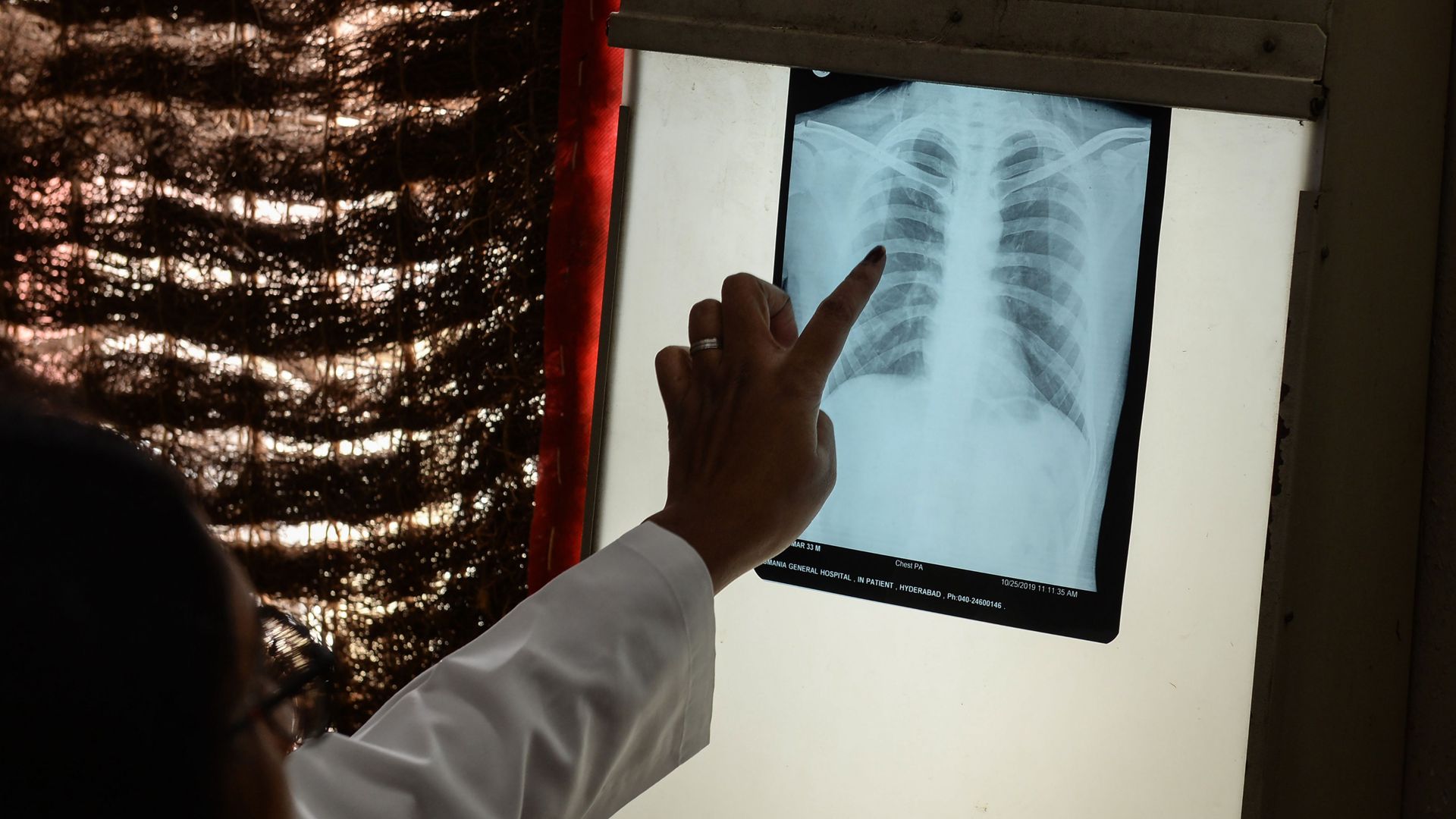 Một bác sĩ kiểm tra phim chụp X-quang phổi của một bệnh nhân ở Hyderabad, Ấn Độ. .