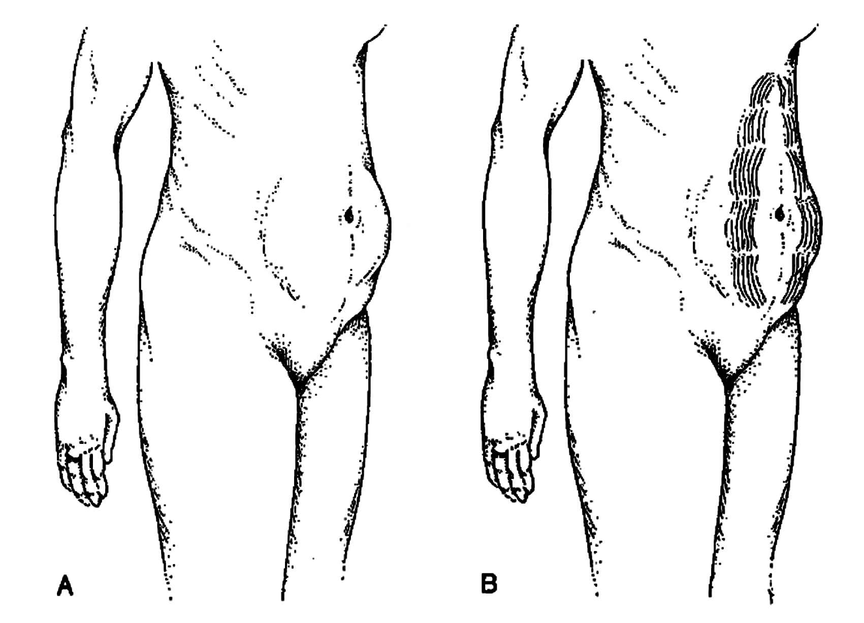 Hình minh họa đối tượng của phẫu thuật tạo hình thành bụng hỗ trợ nội soi. Nguồn: Al Aly et al (2000), Endoscopic plastic surgery, Surgical Clinics Of North America