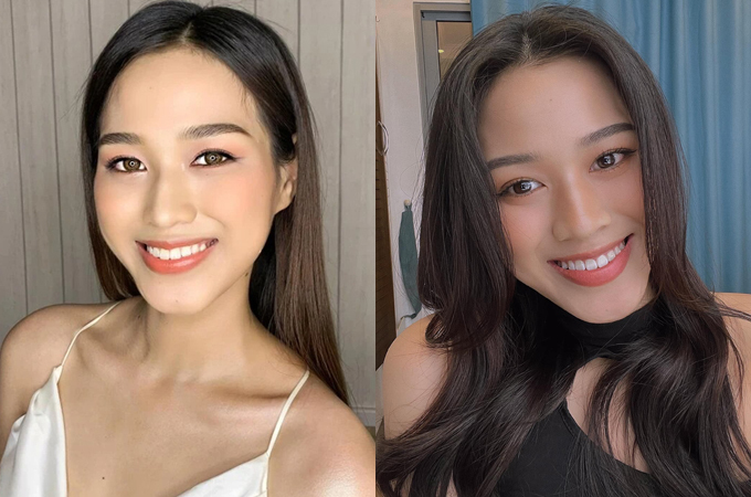 Hoa hậu Việt Nam 2020 vừa hoàn thành quá trình niềng răng. 
