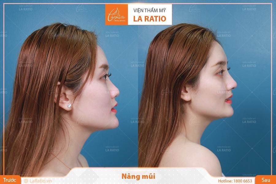 “Mỹ nhân vạn người mê” sau khi nâng mũi bởi bác sĩ Võ Thành Trung - Ảnh: VTM La Ratio cung cấp