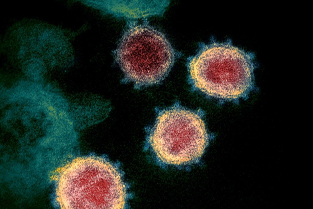 Hình ảnh virus SARS-CoV-2 dưới kính hiển vi