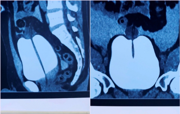 Hình ảnh chụp CT bàng quang của bệnh nhân - Ảnh: BVCC