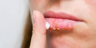 Tẩy da chết bằng đường Khi các tế bào da chết tích tụ trên môi, chúng sẽ ngăn môi bạn nhận được độ ẩm cần thiết. Nhẹ nhàng tẩy tế bào chết cho da bằng đường tẩy tế bào chết giúp loại bỏ các tế bào da chết do nứt nẻ.  Làm một hỗn hợp đường chà là dễ dàng. Tất cả những gì bạn cần làm là làm theo các bước sau:  Cho một thìa đường và một thìa dầu dừa hoặc mật ong vào bát. Trộn đều hỗn hợp và dùng ngón tay sạch thoa hỗn hợp tẩy tế bào chết lên môi. Với hỗn hợp tẩy tế bào chết, hãy nhẹ nhàng chà xát môi của bạn theo chuyển động tròn trong một phút. Lau sạch phần tẩy tế bào chết dư thừa khi bạn làm xong. Thoa dầu khoáng hoặc dầu dừa để phục hồi độ ẩm. Hãy đảm bảo luôn tuân theo phương pháp tẩy tế bào chết bằng đường với phương pháp dưỡng ẩm. Vasyukevich nói: “Nếu bạn quên dưỡng ẩm sau khi tẩy tế bào chết cho môi, nó thực sự có thể khiến đôi môi nứt nẻ trở nên trầm trọng hơn.