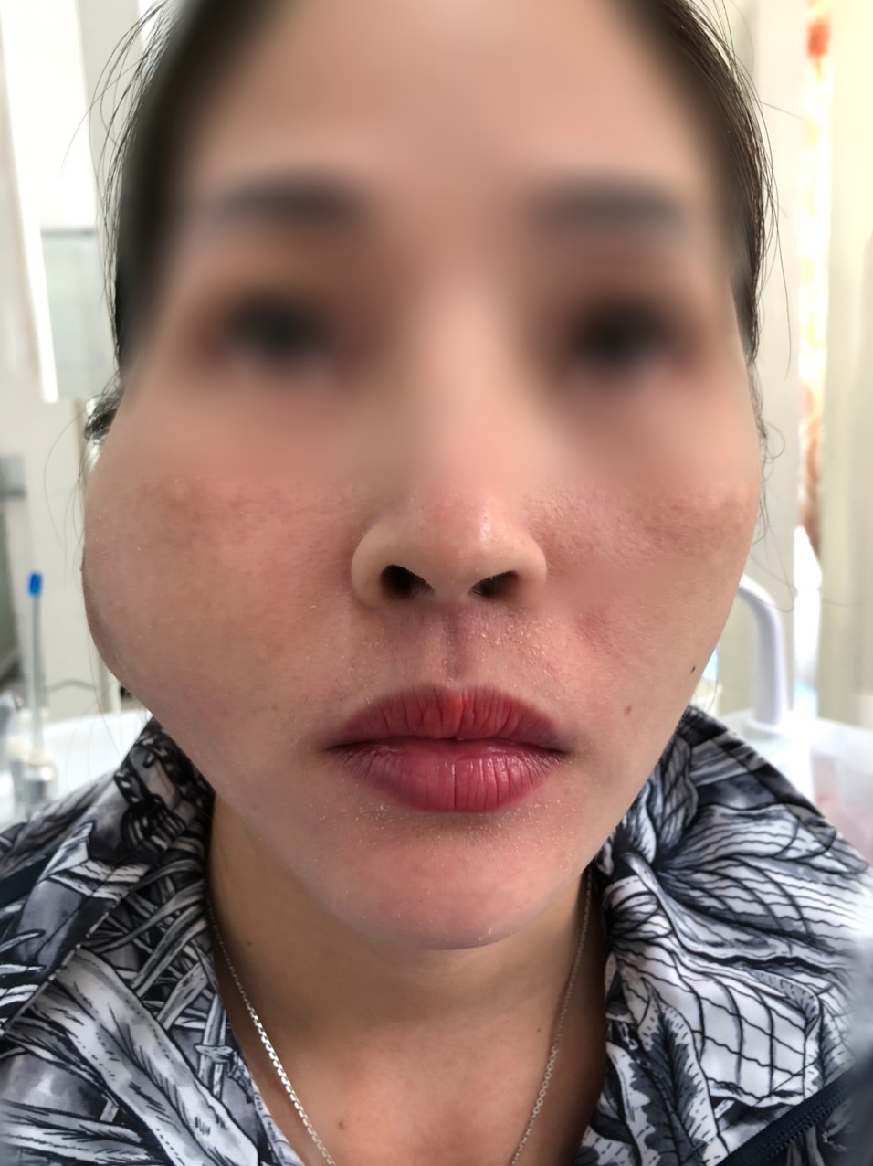 Khuôn mặt chị Q. bị biến dạng khi nhập viện điều trị