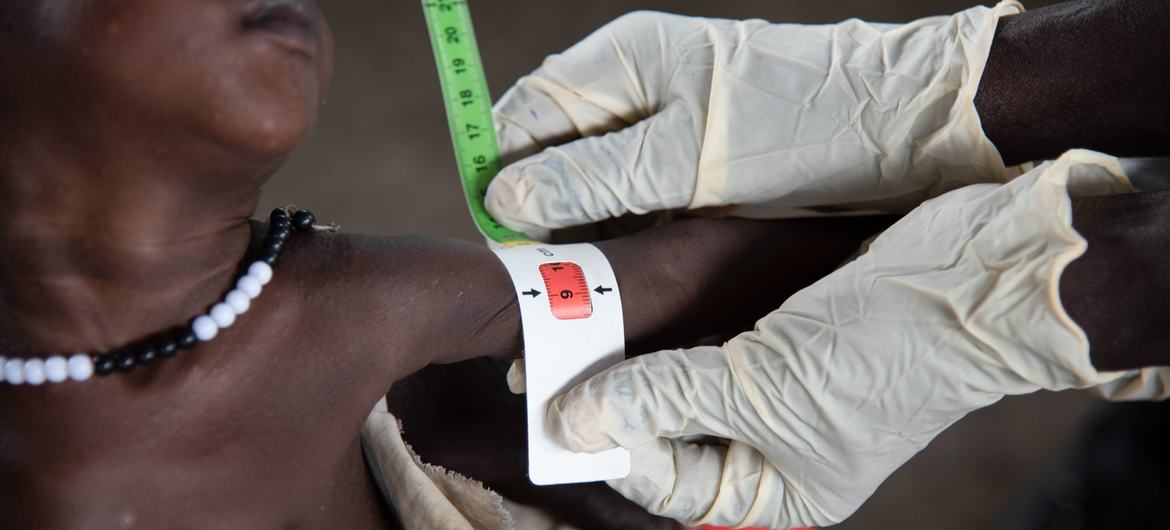 Một em bé suy dinh dưỡng nghiêm trọng đang được chữa trị ở Nam Sudan