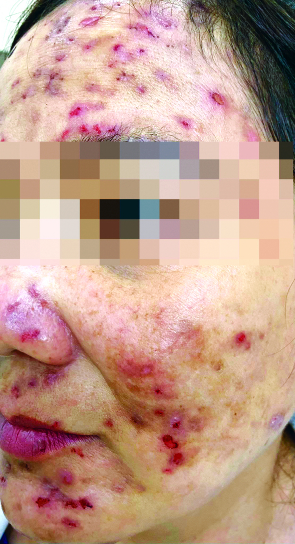 Một bệnh nhân bị viêm da kích ứng sau khi du xuân