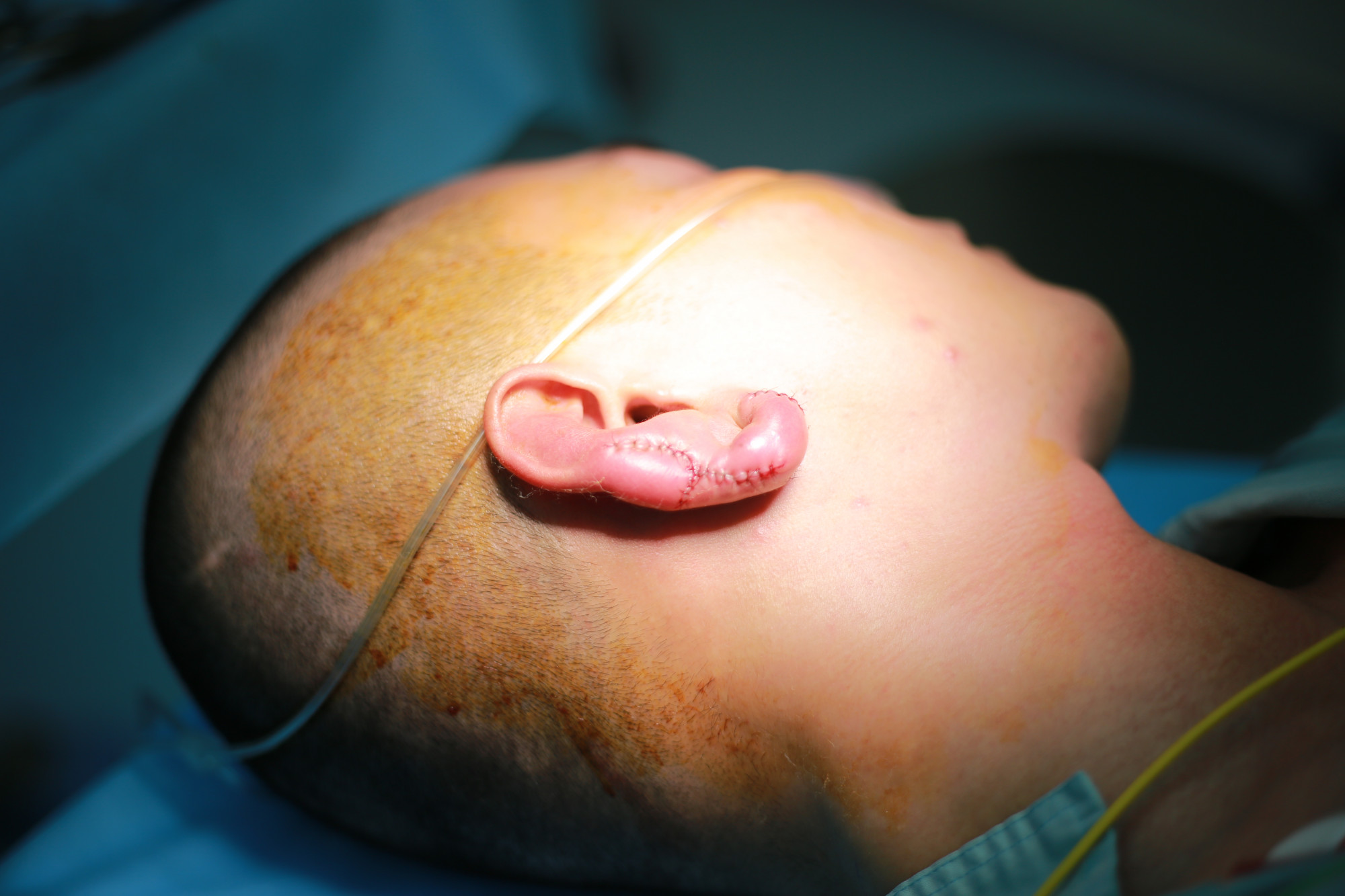 Bác sĩ phải phẫu thuật loại bỏ mô hoại tử và tái tạo lại tai cho bệnh nhân, ảnh BVCC