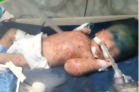 Một trường hợp trẻ sơ sinh mắc thuỷ đậu biến chứng suy hô hấp, viêm phổi nặng phải thở máy - Ảnh: BVCC