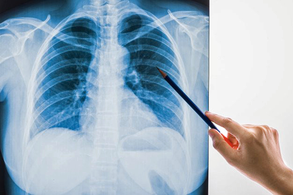 Các bác sĩ khuyến cáo không nên lạm dụng việc chụp X-quang tim phổi và chỉ nên đi khám hậu COVID-19 khi có triệu chứng rõ ràng 