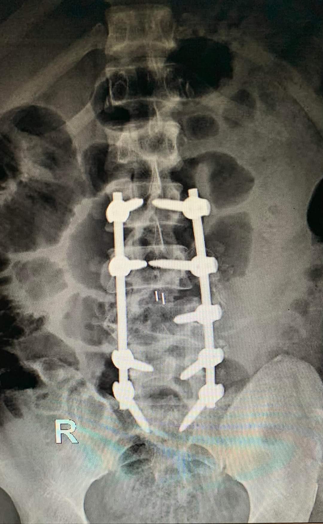 Hình ảnh sau phẫu thuật, cột sống đươc cố định bằng nẹp vít chuyên dụng