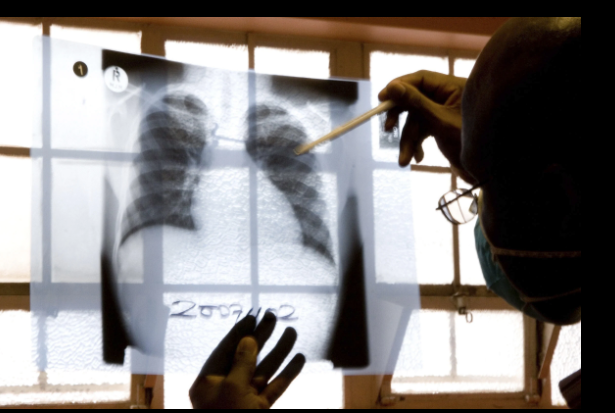 Một bác sĩ chụp X-quang phổi tại một phòng khám bệnh lao. Ảnh: AP