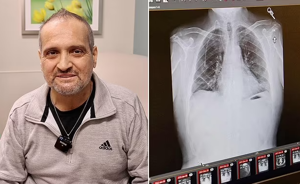 Albert Khoury (ảnh), 54 tuổi - một người không hút thuốc - hiện đã khỏi ung thư 6 tháng sau khi được ghép phổi đôi đã cứu sống ông, mang lại hy vọng cho những người khác mắc bệnh giai đoạn nặng.