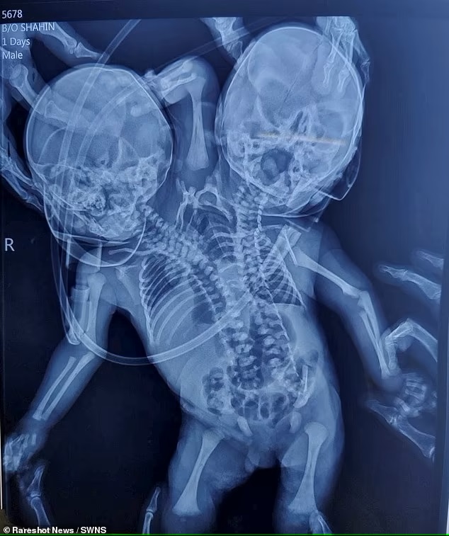 ảnh chụp X quang cho thấy hai đứa trẻ dính với nhau hoàn toàn từ phần ngực trở xuống