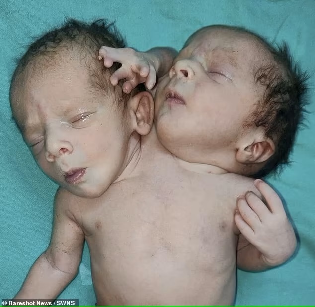 Cặp song sinh dính liền vừa ra đời tại Ấn Độ 