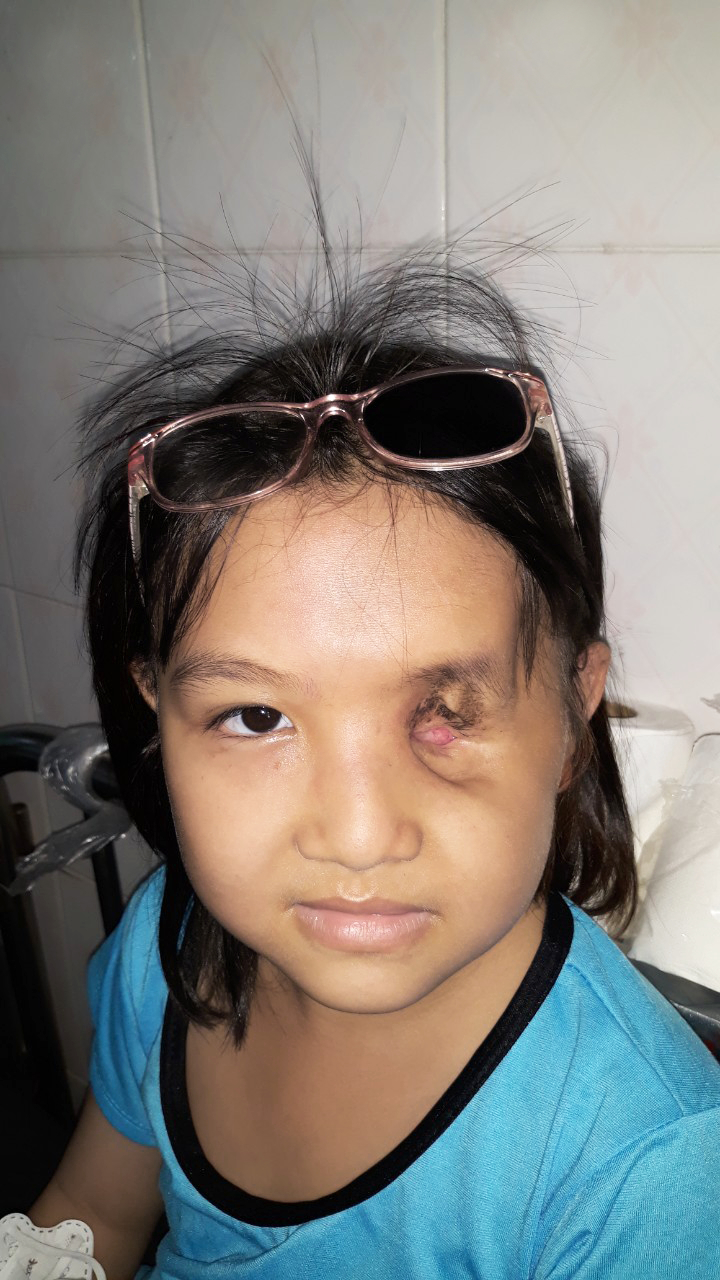 Khối u trên mắt bé Thanh Diệu đã teo lại  sau quá trình hóa trị, nhưng theo các bác sĩ, em vẫn cần phải tiếp tục được điều trị