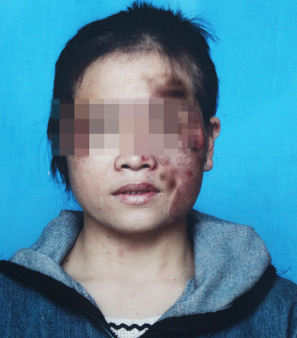 Hình ảnh một phụ nữ bị chồng đánh bầm dập  do không chịu quan hệ tình dục ở tỉnh Tây Ninh  được Báo Phụ Nữ TP.HCM phản ánh năm 2020