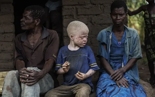 Một đứa trẻ bạch tạng với bố mẹ ở quận Nkole, Machinga. Những người mắc bệnh bạch tạng đã phải đối mặt với bạo lực ở Malawi, với các bộ phận cơ thể của họ đôi khi được sử dụng trong các nghi lễ phù thủy. Ảnh: Gianluigi Guercia / AFP / Getty