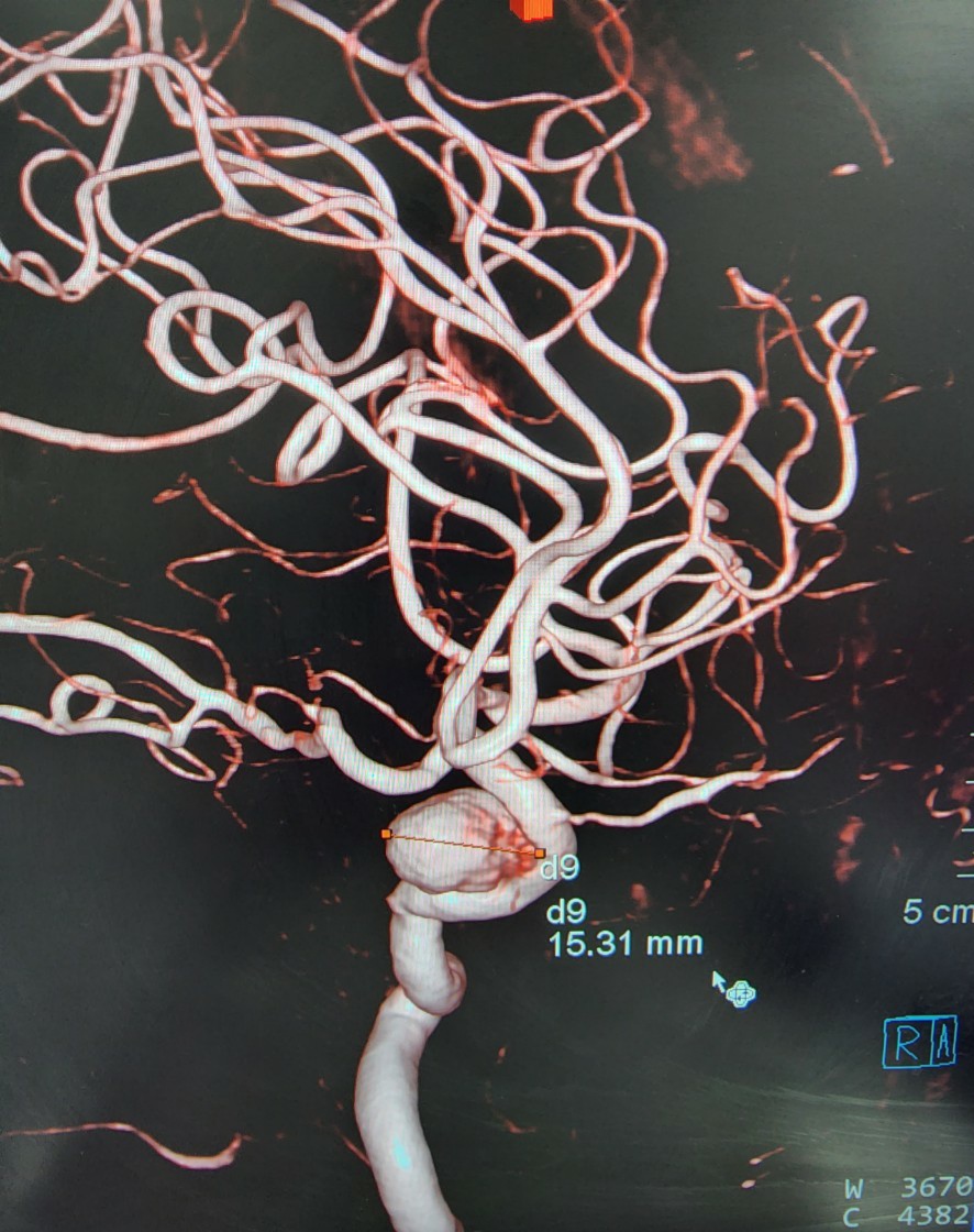 Hình ảnh túi phình động mạch não