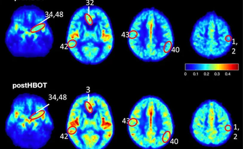 Kết quả nghiên cứu cho thấy lưu lượng máu tăng lên và cải thiện oxy trong não của bệnh nhân bị suy giảm nhận thức (tín dụng ảnh: Aging / Uri Ashery)